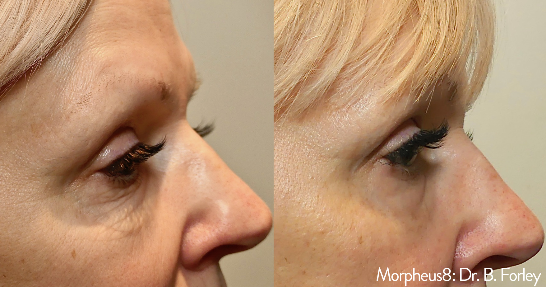 morpheus8-before-after-dr-b-forley-preview-2